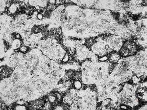 M,44y. | spleen - Gaucher disease M,44y. | spleen - Gaucher disease
